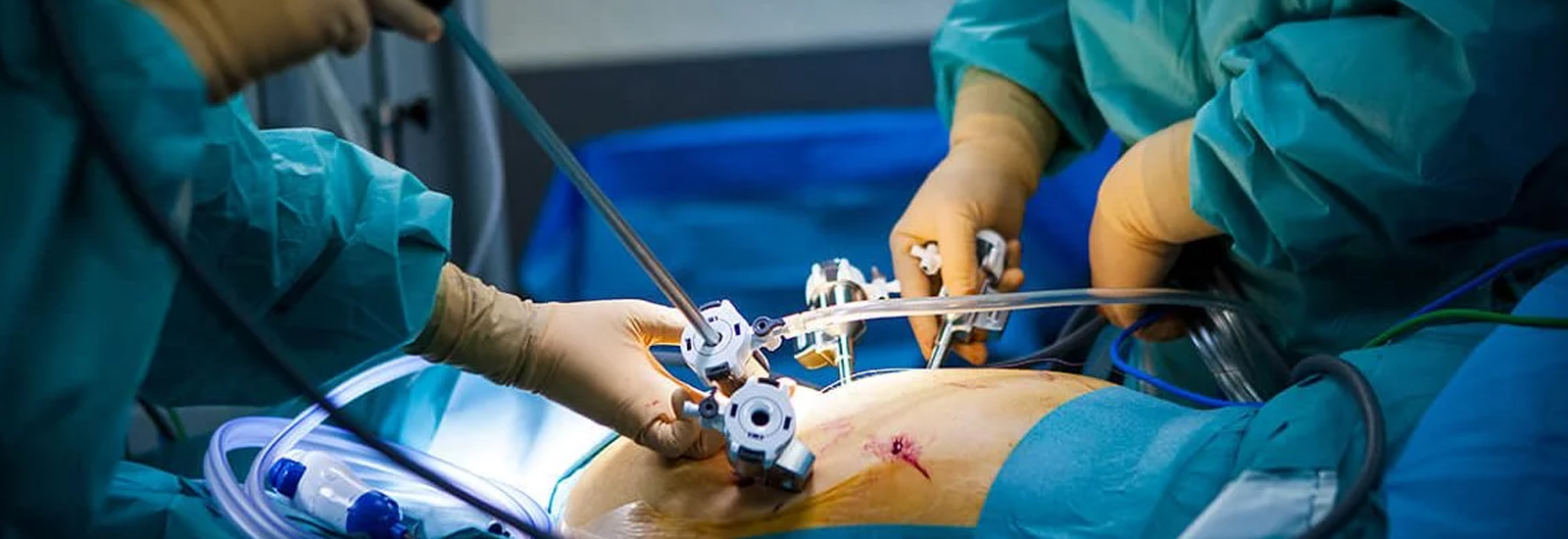 Laparoscopy